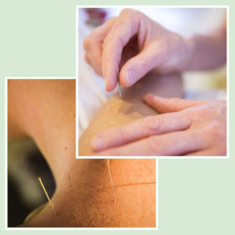 Akupunktur nåler