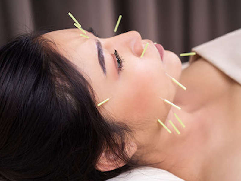 facial-acu Acupuncture